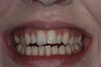 Original teeth