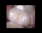 Broken tooth restored with onlay