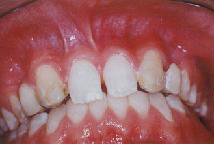 Teeth worn and discolored